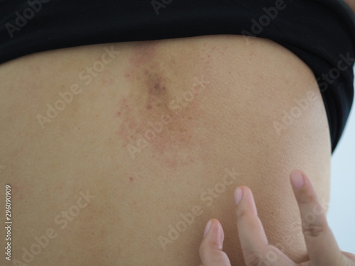 heat rash or prickly heat or miliaria in asian woman and scratching her back skin. Cause of wash clothes not clean and has a stale or musty use for liquid detergent and fabric softener product.