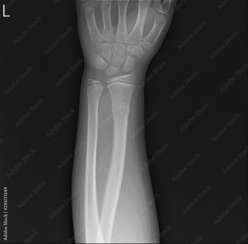 radiograph of the left forearm with a fracture of the radius radiograph of the left forearm with a fracture of the radius