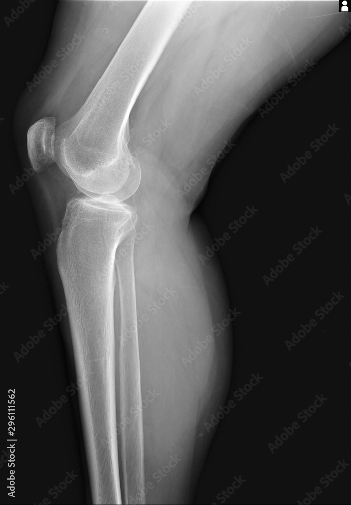 normal x-ray of the knee joint normal x-ray of the knee joint