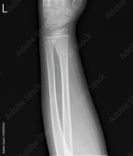 radiograph of the left forearm with a fracture of the radius