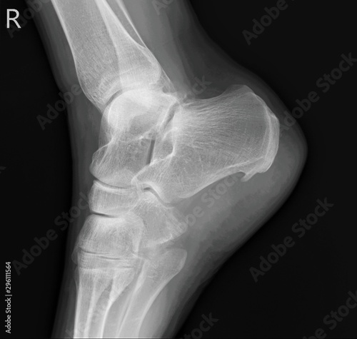 heel spur on the x-ray of the right heel bone photo