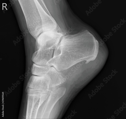 heel spur on the x-ray of the right heel bone