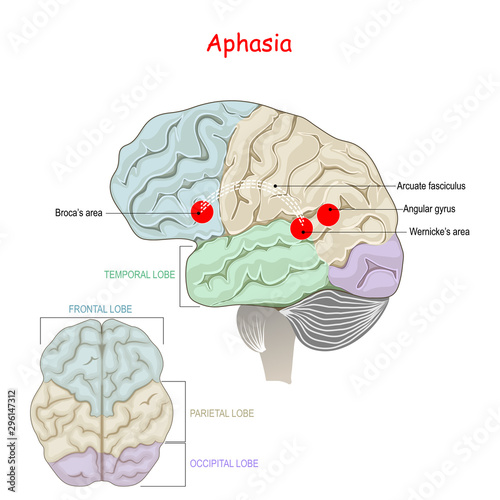 Aphasia. Human Brain with damage to specific areas.