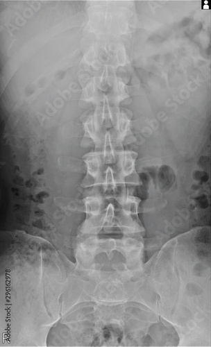 radiograph of the lumbar spine in direct projection