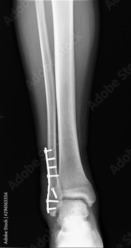 on the radiograph of the ankle joint fixation of the fracture with a plate with screws