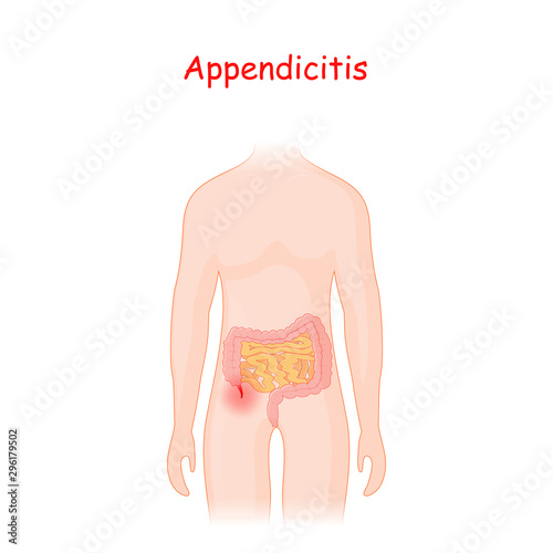 appendicitis. human silhouette with a colon, small intestine and an inflamed appendix.