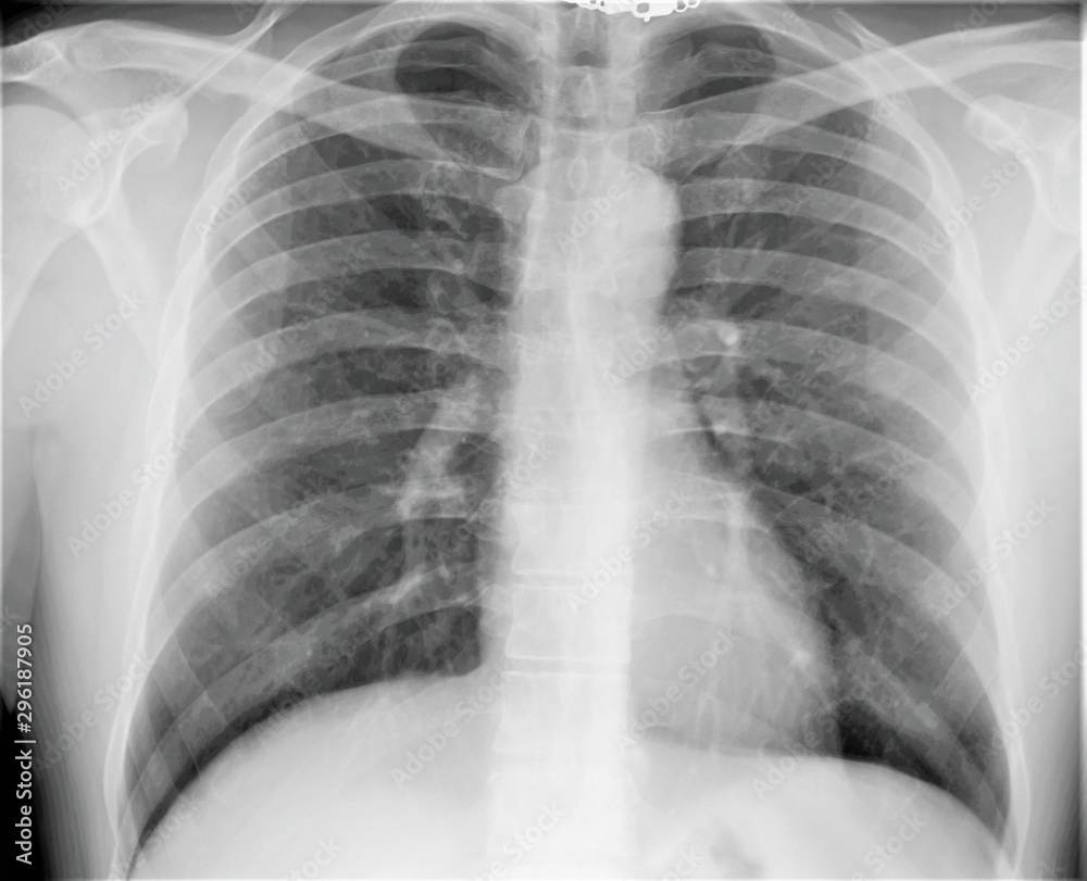 normal radiography of the chest and lungs normal radiography of the chest and lungs