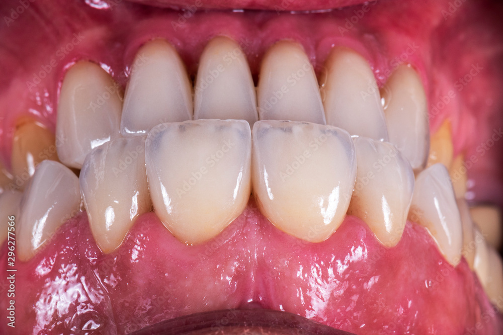Obraz premium press ceramic 8 unit natural look veneers
