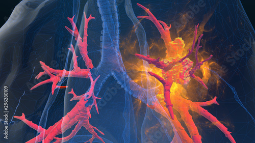 3d rendered illustration of lung cancer 3D illustration
