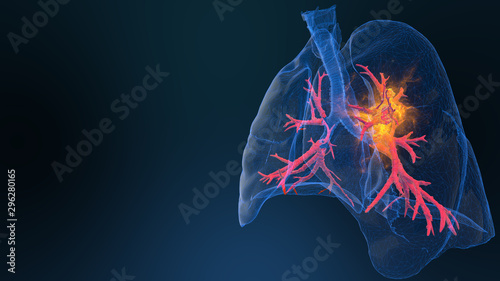 3d rendered illustration of lung cancer 3D illustration