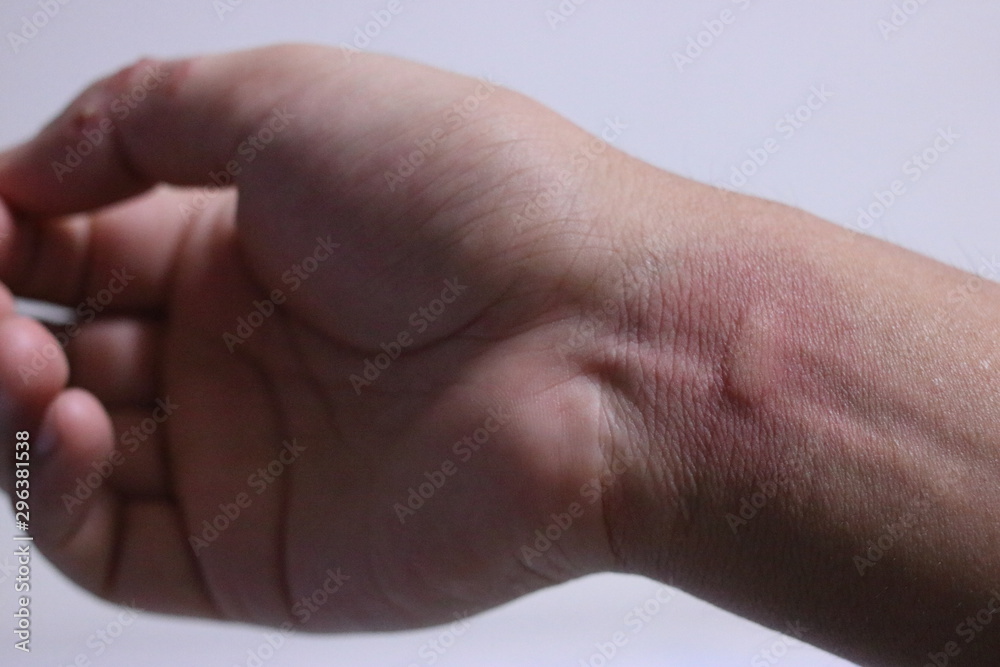 虫刺されで炎症している手首 虫刺されで炎症している手首