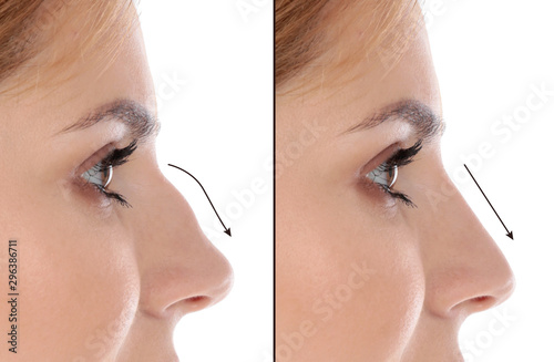 Woman before and after plastic surgery on white background photo