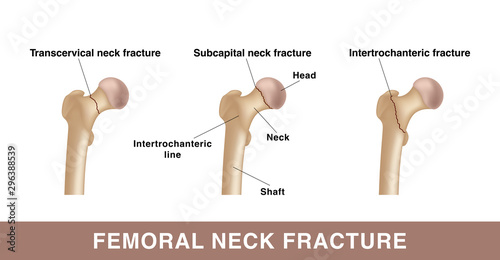 Three types of femoral neck fracture. Realistic drawing showing broken bone with inscriptions isolated on whie background.