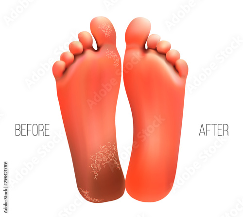 Two feet with cracks and without. Clean and tidy. Vector illustration