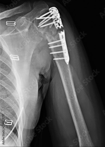 on the radiograph, the fracture of the humerus head is fixed with a plate with screws medicine and structural failure, diagnostics,traumatology,orthopedics, osteosynthesis