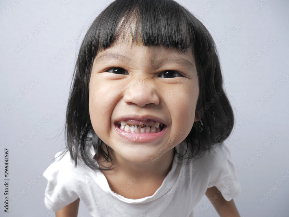 Little Girl Smiling Shows He Decay Tooth Little Girl Smiling Shows He Decay Tooth
