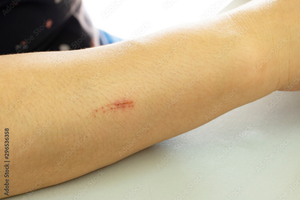 skin scratched remove scar arm treatment remove