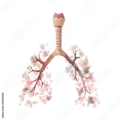 Vector illustration of lung cancer