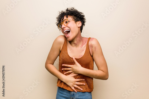 Young african american woman with skin birth mark laughs happily and has fun keeping hands on stomach.