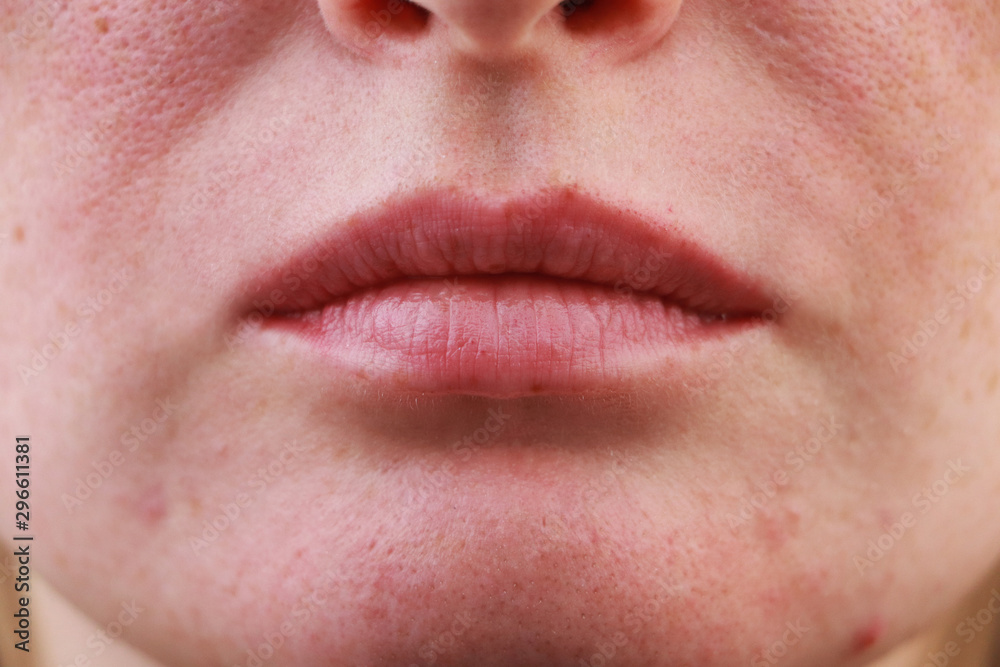 Expanded pores, acne, comedones, black spots. Lips close up. Problem skin girl Expanded pores, acne, comedones, black spots. Lips close up. Problem skin girl