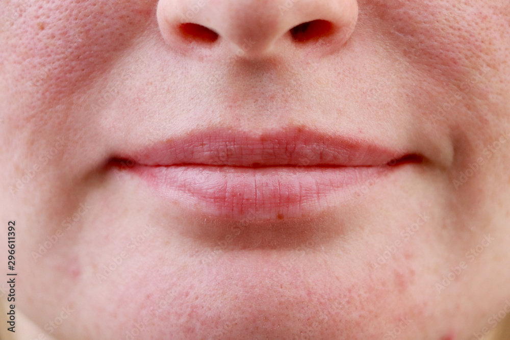 Expanded pores, acne, comedones, black spots. Lips close up. Problem skin girl Expanded pores, acne, comedones, black spots. Lips close up. Problem skin girl