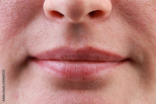 Expanded pores  acne  comedones  black spots. Lips close up. Problem skin girl