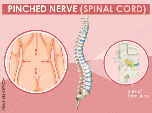 Diagram showing pinched nerve in human photo