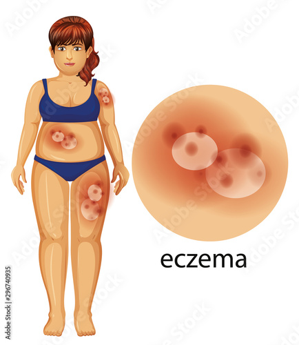 Diagram showing woman with eczema