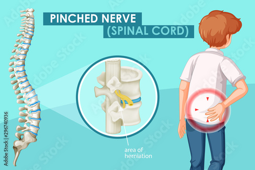 Diagram showing pinched nerve