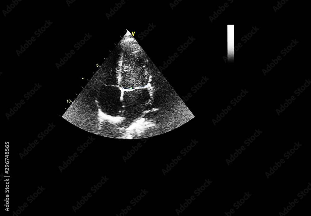 Screen of echocardiography (ultrasound) machine. Screen of echocardiography (ultrasound) machine.