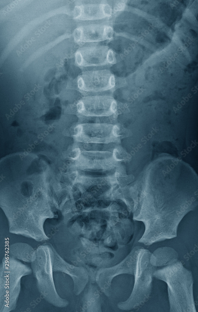Lumbosacral spine (LS spine) xray, anteroposterior (AP) view, a 2 year