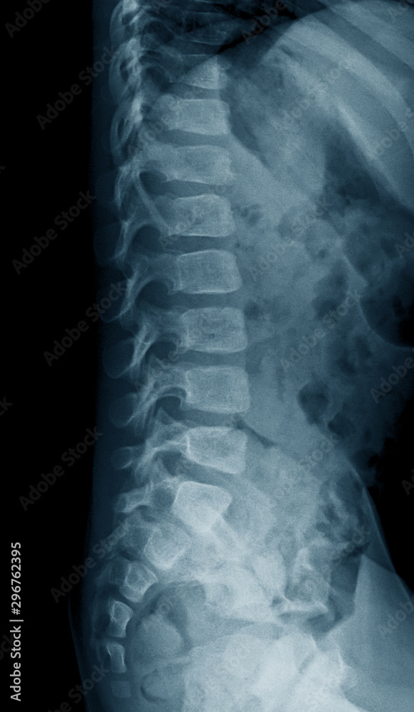 Lumbosacral spine (LS spine) xray, lateral view, a 2 year old asian