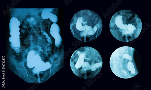 Lower gastrointestinal (GI) tract radiography (lower GI or barium enema), an x-ray examination of the large intestine (colon) photo