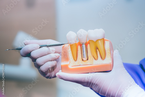 Fototapet Dentist with tooth implant false teeth