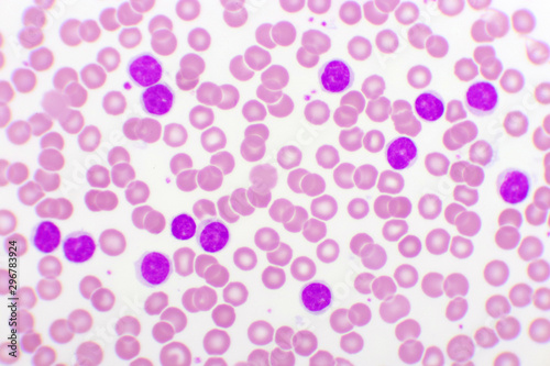 Blood picture of chronic lymphocytic leukemia or CLL, analyze by microscope, original magnification 400x