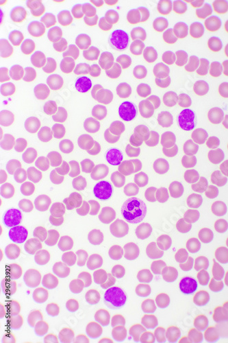 Blood picture of chronic lymphocytic leukemia or CLL, analyze by microscope, original magnification 400x