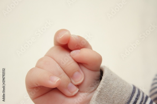  Polydactyly  Preaxial, Polydactyly on human; rare abnormal characteristic causes by chromosome, Disorders of Hands, six fingers in one hands