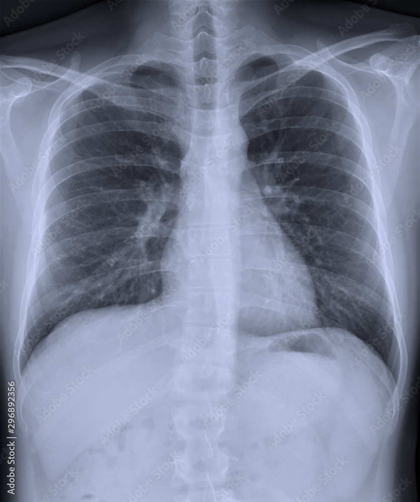 Film x-ray chest PA upright with normal lungs. Film x-ray chest PA upright with normal lungs.