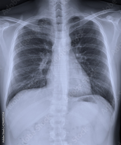 Film x-ray chest PA upright with normal lungs.