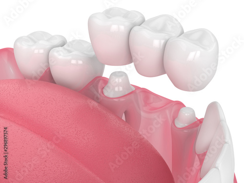 3d render of jaw with dental bridge