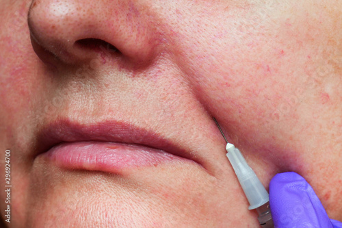 cosmetic injections under the skin of a woman's face, anti-aging procedure, Nasal Labial Folds