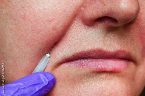 cosmetic injections under the skin of a woman's face, anti-aging procedure, Nasal Labial Folds photo
