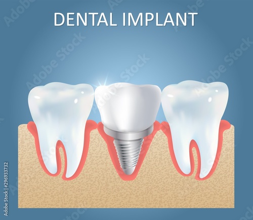 Dental implant vector medical poster design template
