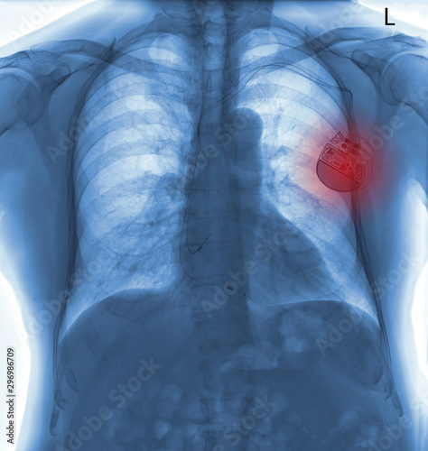 Invert Chest X-ray with pacemaker placement