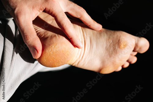 fungus on the foot of the foot. A close-up photograph of a male foot. 