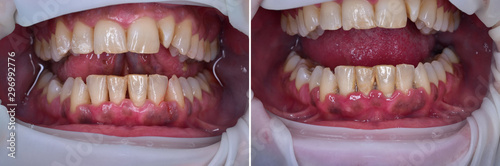 treatment of gum disease by deep cleaning