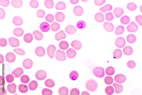 Malaria parasite in red blood cells, ring form stage of Plasmodium falciparum, original magnification 1000x photo