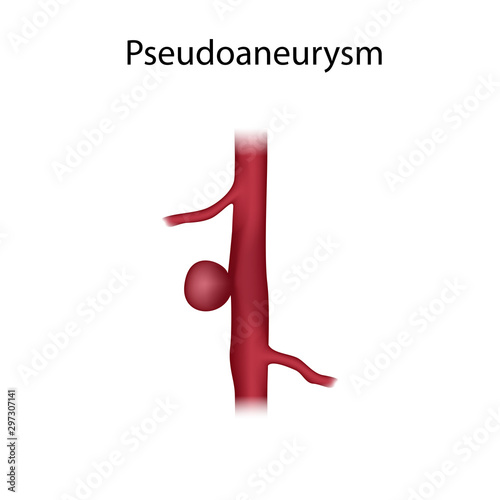 Pseudoaneurysm. Blood vessel, artery. Medical anatomy illustration. photo