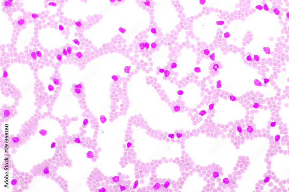 Blood picture of chronic lymphocytic leukemia or CLL, analyze by microscope, original magnification 400x