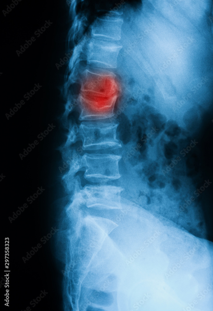 Thoracolumbar spine (TL spine) Xray, lateral view, showing spinal